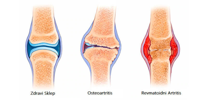 bolečine v sklepih